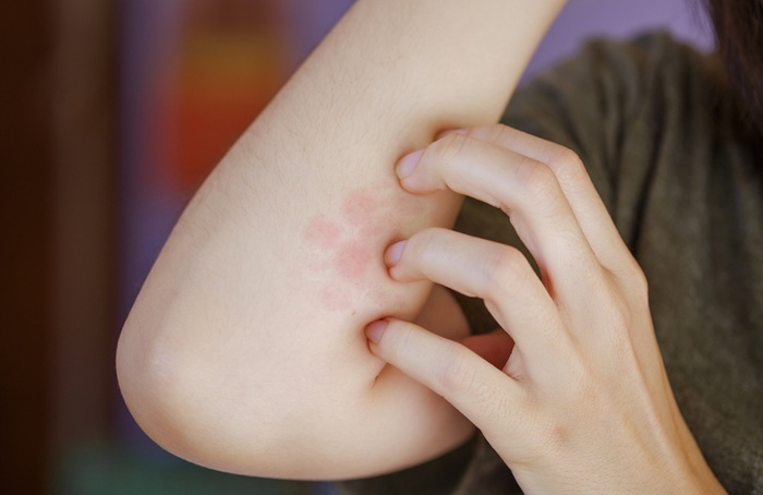 Health officials warn of rapidly spreading skin infection